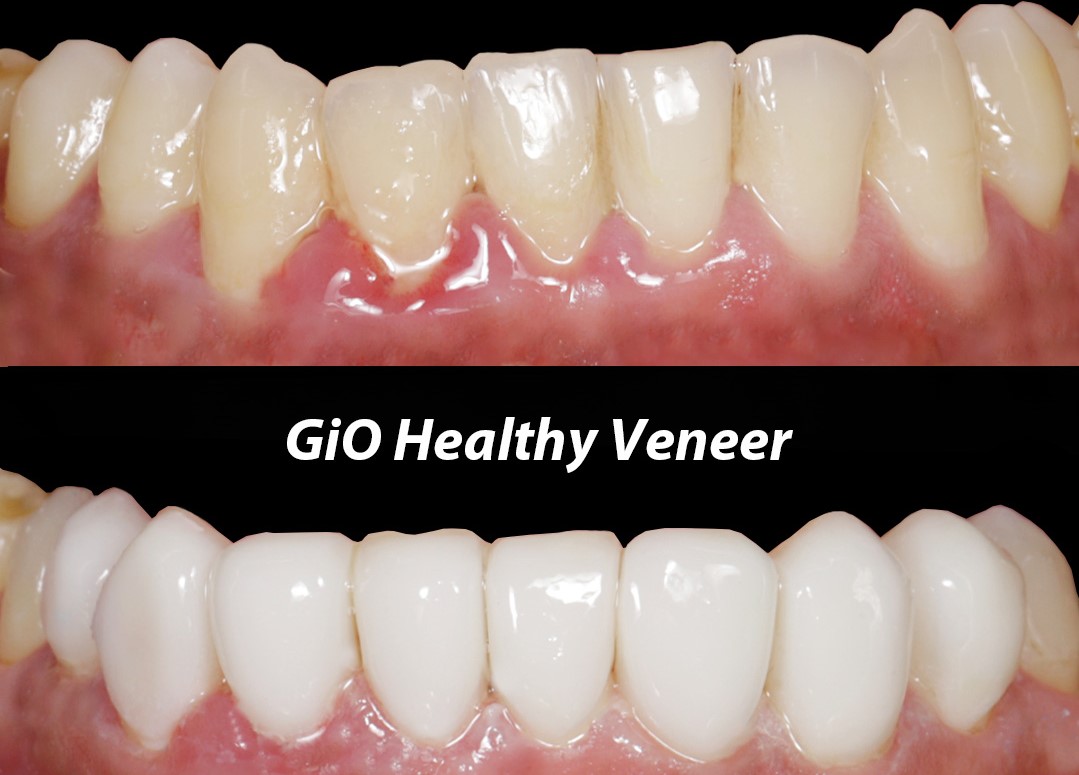 gio-healthy-veneer--veneer-gigi